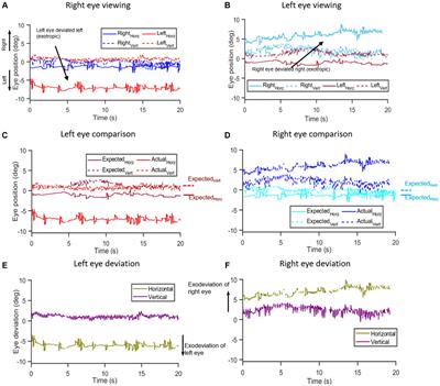 Objective assessment of eye alignment and disparity-driven vergence in Parkinson’s disease